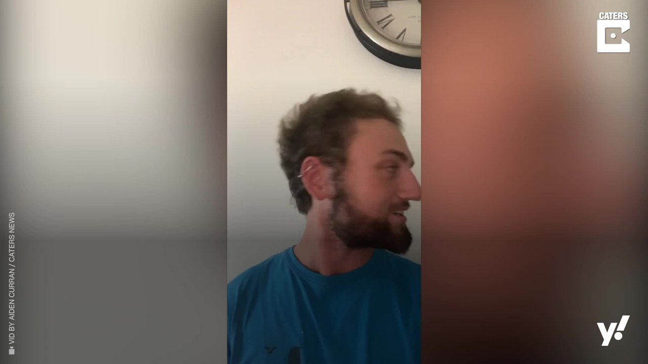 21-Jähriger hat nach Haartransplantation wieder volles Haar