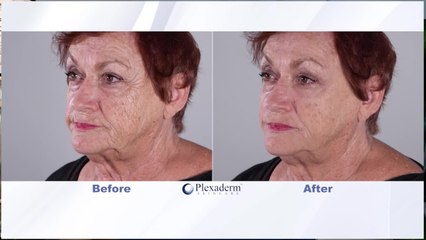 Look how fast you can look younger with Plexaderm