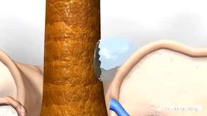 Starkes Schwitzen: Die Ursachen