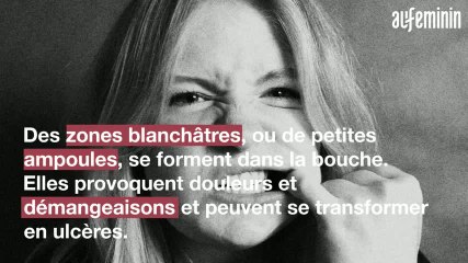 Tout savoir sur les stomatites aphteuses ou herpétiques