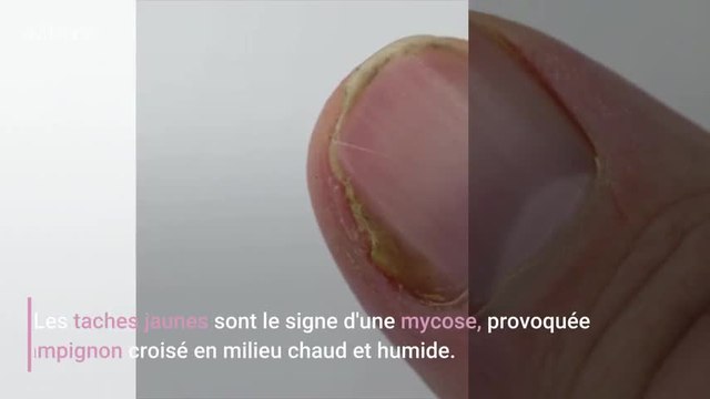 Quelles sont ces taches sur vos ongles