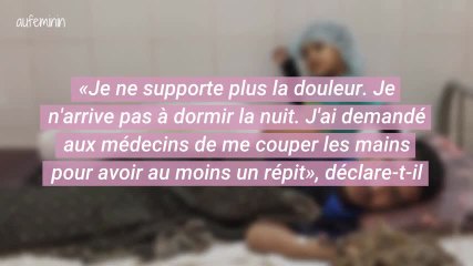 "L'homme arbre" souhaite être amputé pour mettre fin à ses souffrances