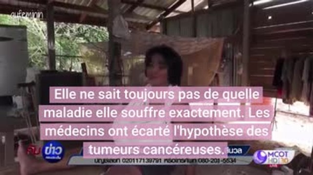 Atteinte d'hypertrophie mammaire, cette femme voit sa poitrine augmenter de volume depuis 9 mois
