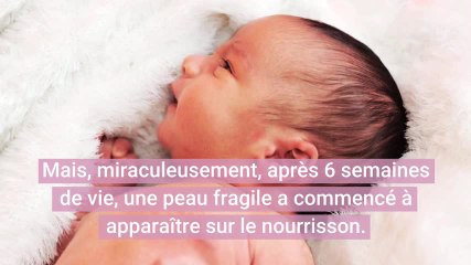 Un bébé né sans peau parvient à survivre