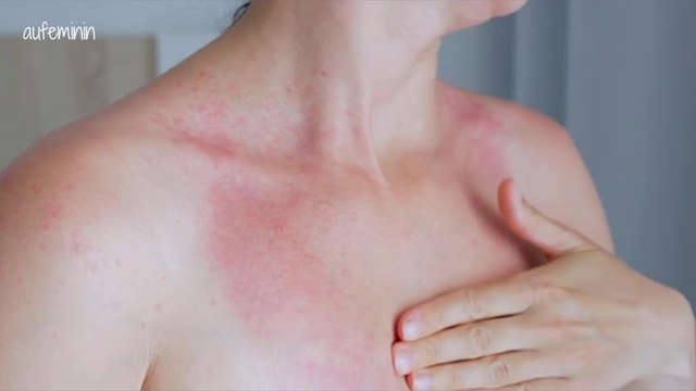 Les 5 dangers du soleil sur notre beauté