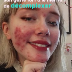 Hailey Wait assume son acné sur Instagram