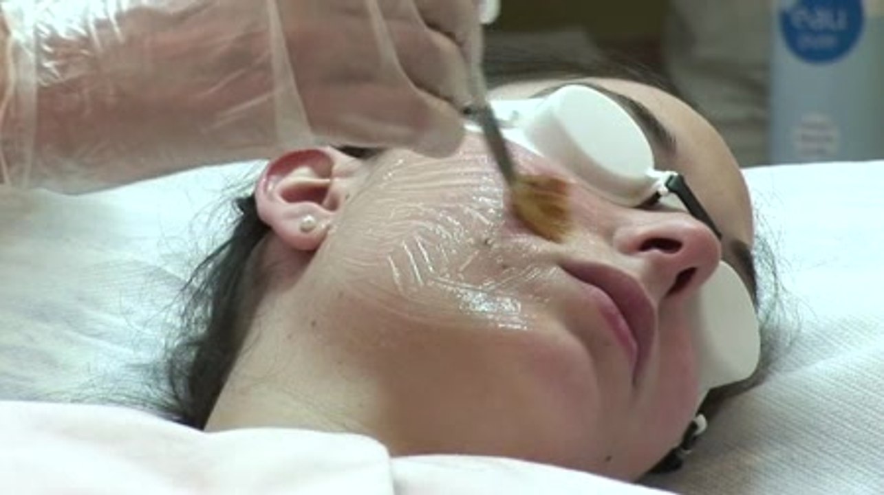 Traitement de l'acne adulte au laser