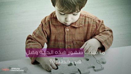 ما سبب ظهور هذه الحبة وهل هي خطيرة؟