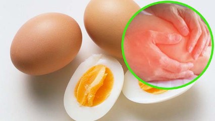 Uric Acid के मरीज खा सकते हैं अंडा? जानें किन बातों का ध्यान रखना जरूरी । Boldsky