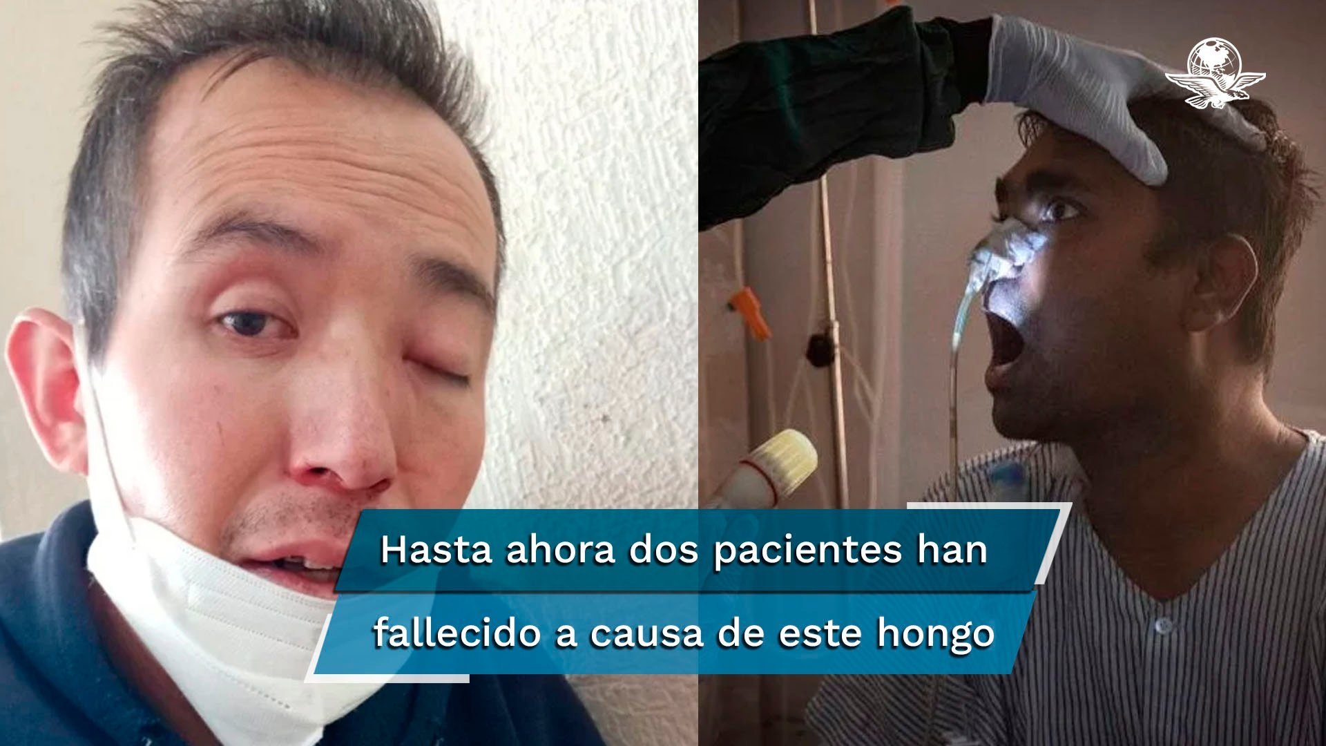 ⁣Los casos más recientes de hongo negro que se han registrado en México