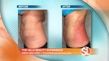 The Hills Beauty Experience: How to tighten skin and get rid of fat
