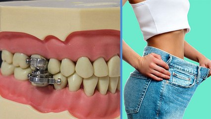 Weight Loss के लिए आई जबरदस्त Dental Slim Diet Device, कैसे चुटकियों में घटाएगी वजन | Boldsky