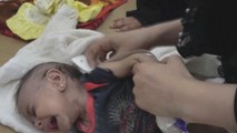 بفعل الحرب.. سوء التغذية الحاد يهدد حياة الأطفال باليمن