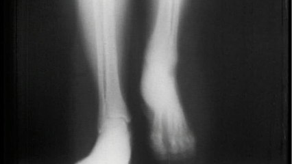 Doctor identifies 'bone death' as long COVID complication