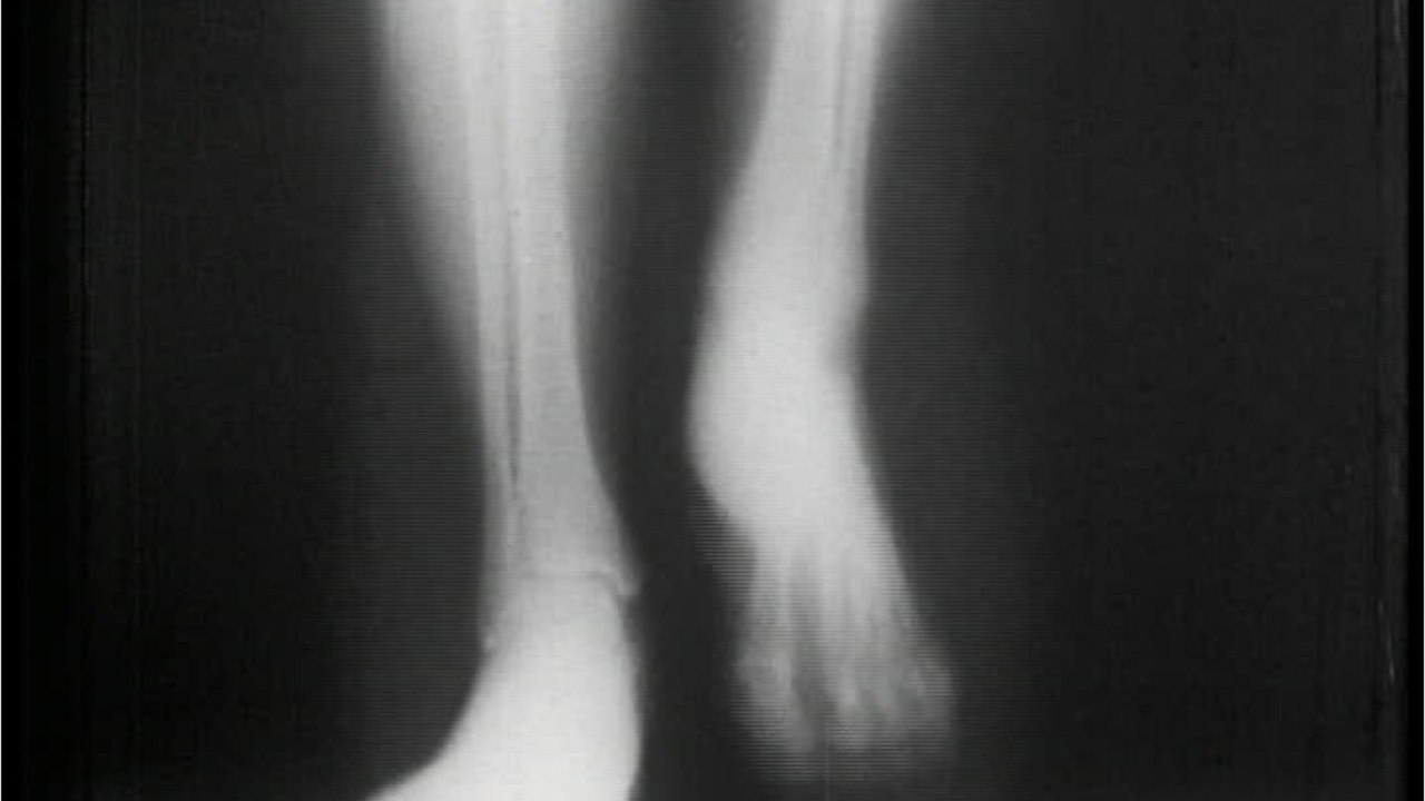 Doctor identifies 'bone death' as long COVID complication