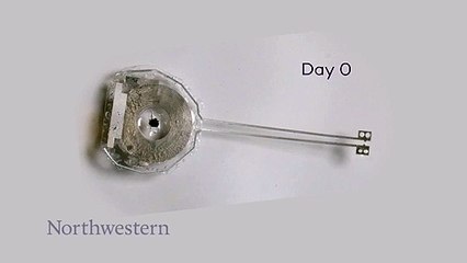 First-ever transient pacemaker harmless dissolves in the body