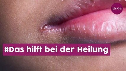 Was hilft bei eingerissenen Mundwinkeln