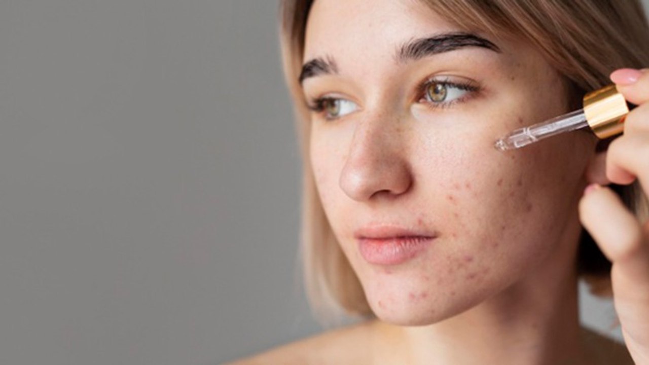 Punya Bekas Bopeng di Wajah? Begini Cara Mengobatinya di Rumah