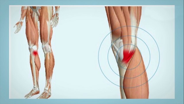 bd-tendinitis-de-la-pata-de-ganso-causas-sintomas-y-tratamientos-070721