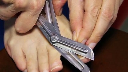 Tırnak batması tedavisi