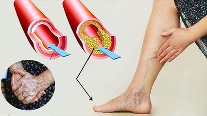 Post Corona Recovery के बाद लोगों में ब्लॉक नसें, काली पड़ रहीं उंगलियों की परेशानियां आई सामने