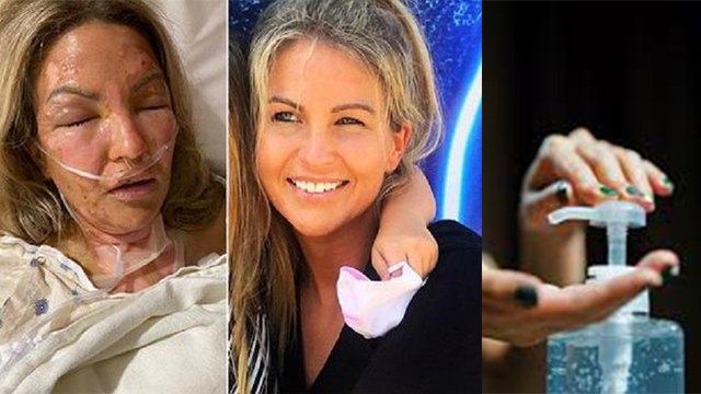 Hand Sanitizer Bottle में ब्लास्ट से बुरी तरह जली महिला, Use करते वक्त करें ये काम | Boldsky