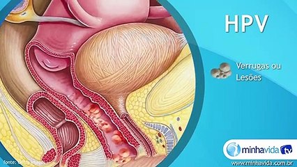 HPV: doença sexualmente transmissível pode causar verrugas genitais