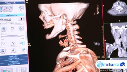 Tumor maligno e benigno: qual a diferença entre eles? - Dúvidas sobre câncer