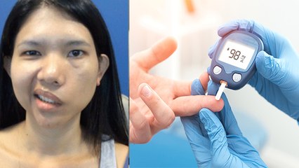 Corona Recovery के बाद 3 तरह के Patients को Bells Palsy का खतरा | Boldsky