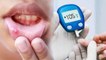 मुंह में Diabetes के 3 खतरनाक लक्षण चौंका देंगे | Diabetes Symptoms in mouth | Boldsky