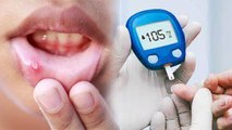 मुंह में Diabetes के 3 खतरनाक लक्षण चौंका देंगे | Diabetes Symptoms in mouth | Boldsky