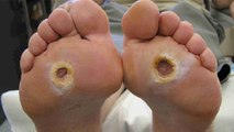 Diabetes Patients में Diabetic Foot Ulcer का खतरा, Symptoms ना करें नजरअंदाज | Boldsky