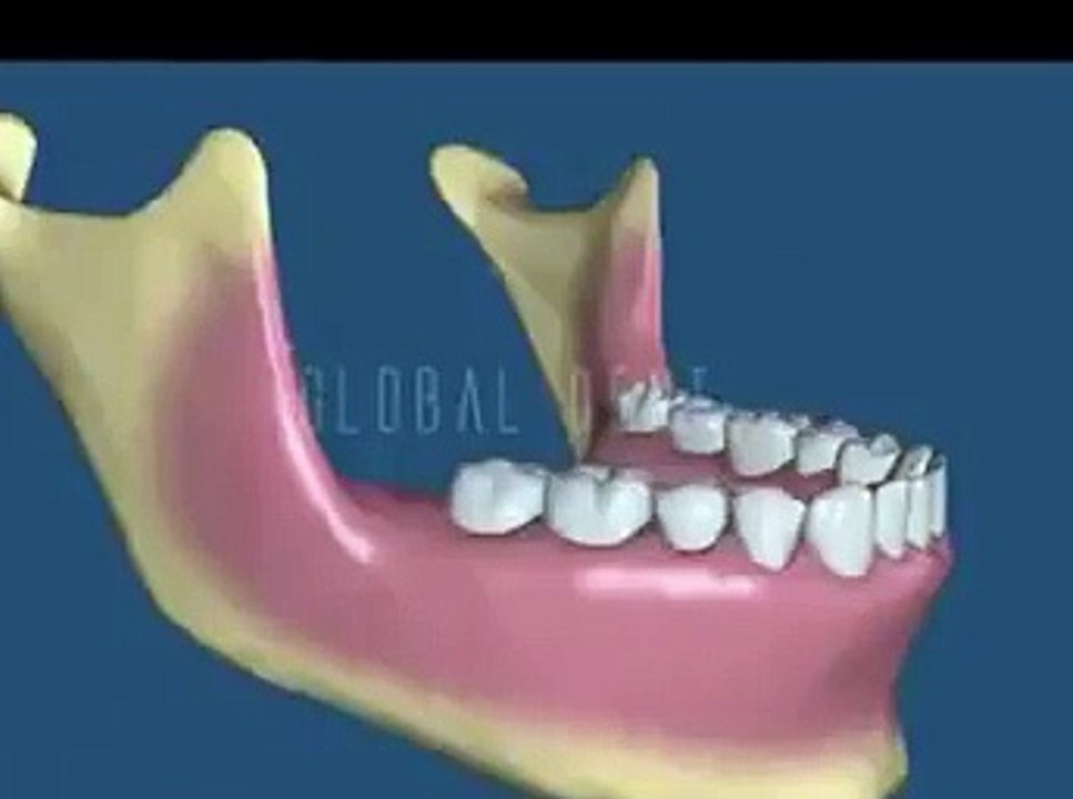 20'lik diş çekimi 