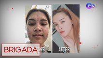 Brigada: Acne breakout, paano maiiwasan?