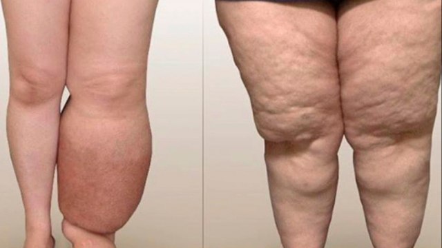 bd-relacion-entre-obesidad-o-sobrepeso-y-piernas-inflamadas-120721