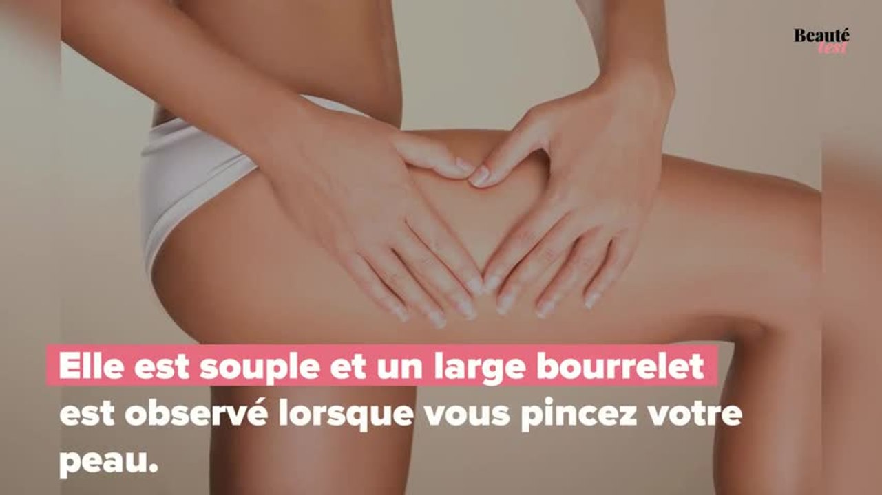 Comment déterminer son type de cellulite
