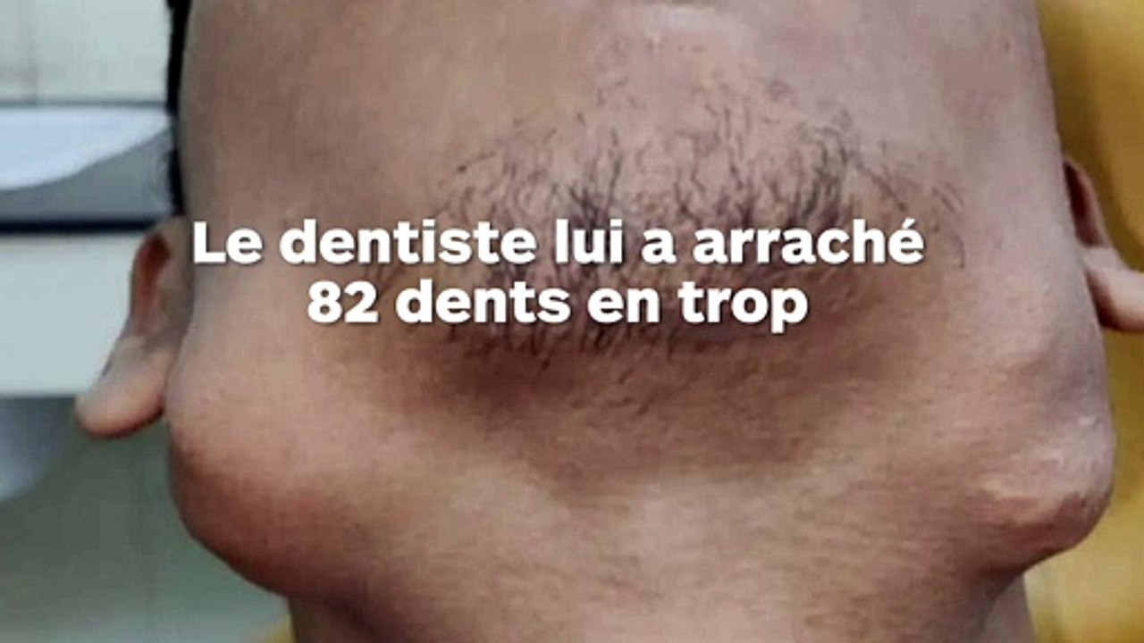 On lui arrache 82 dents en trop dans la bouche