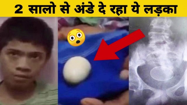 2 साल से अंडे दे रहा है ये लड़का रिपोर्ट देखकर डॉक्टर भी रह गए सन्न ! Indonesian Boy ‘Laid 20 Eggs