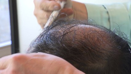 지난해 탈모 환자 23만 명...30대가 가장 많아 / YTN