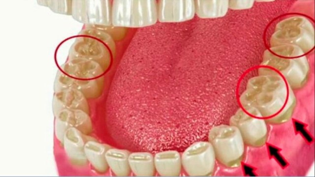 bd-causas-y-tratamientos-para-quebraduras-ydesgaste-dental-150721