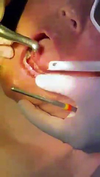 Laser Teeth Whitening | Phoenix AZ