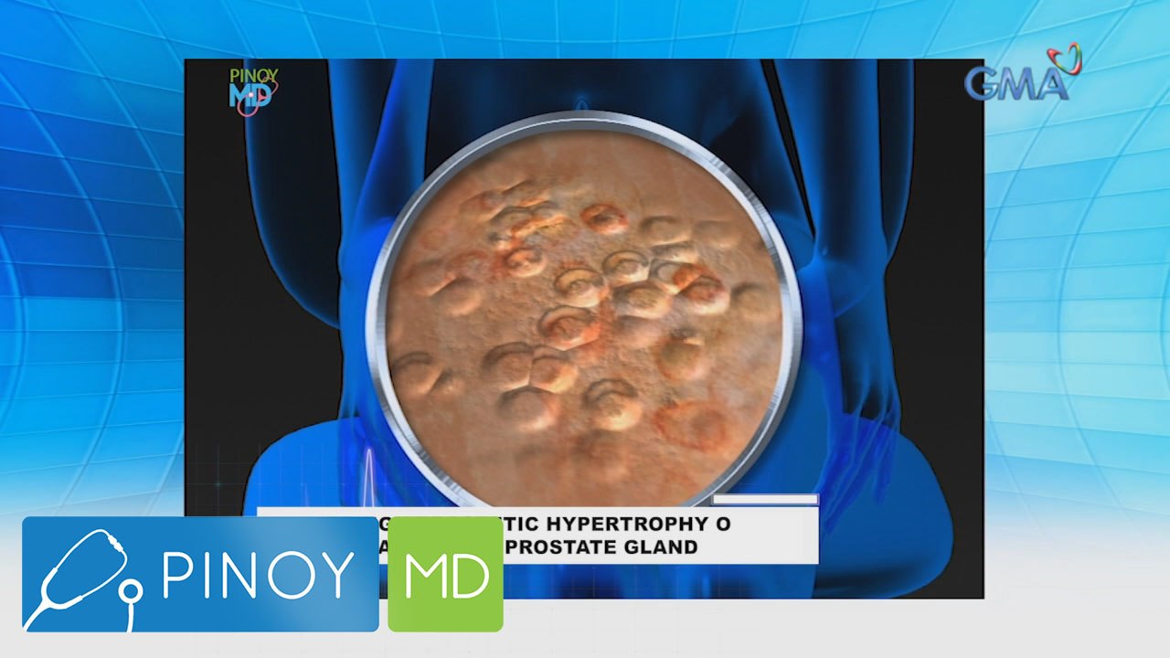 Pinoy MD: What are the symptoms of genital warts?