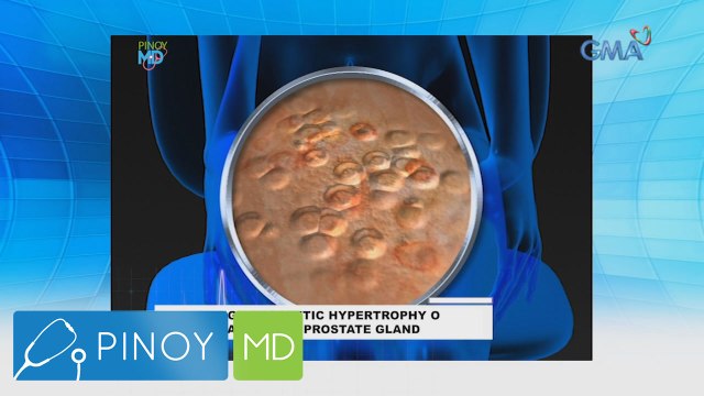 Pinoy MD: What are the symptoms of genital warts?