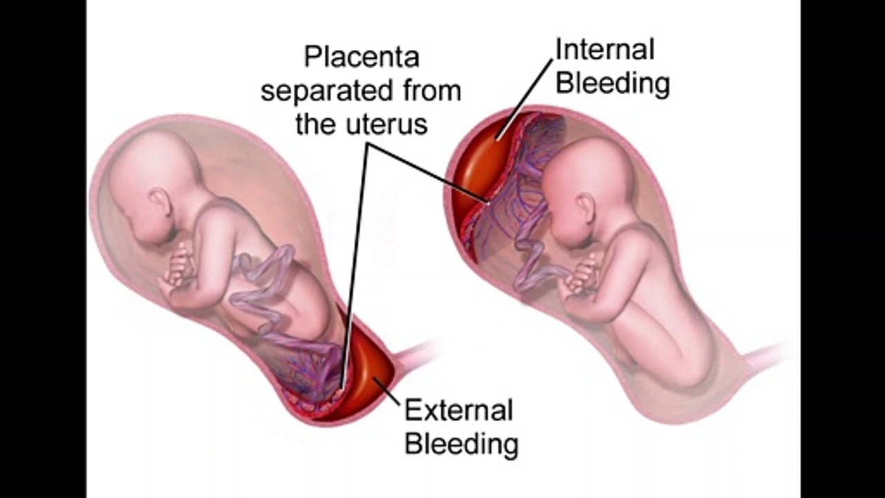 Placental abruption Urdu video