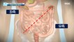 [HEALTHY] How to Conquer Colon Cancer! Understand the Colon Cancer Map?!, 기분 좋은 날 210719
