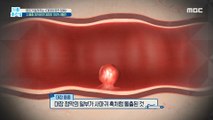 [HEALTHY] IF You Remove It, You'll get 100% COLON CANCER., 기분 좋은 날 210719