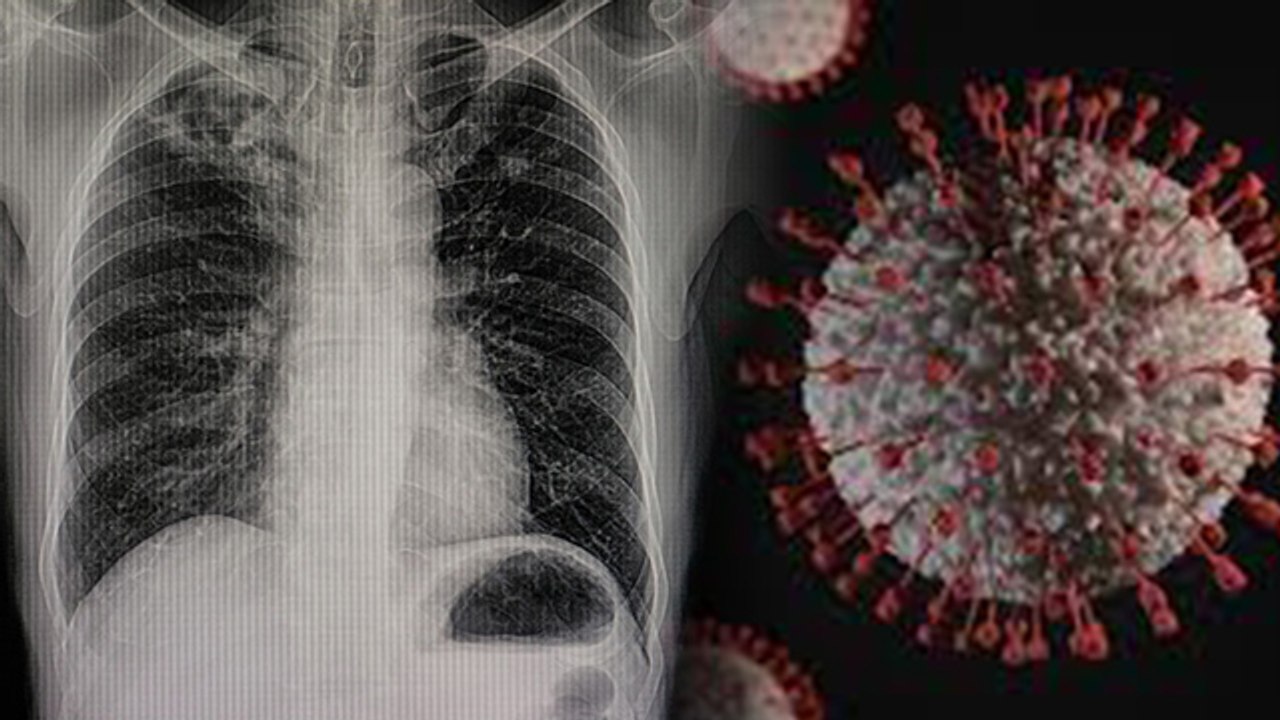 Coronavirus से खराब हुए Lungs इतने Months बाद अ...