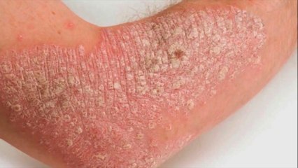 bd-hablamos-de-los-tratamientos-para-la-psoriasis-190721