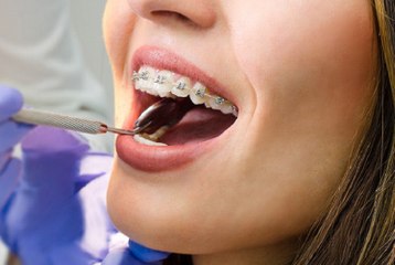 Odontólogo diz que tratamento ortodôntico tem que ser concluído sem pressa para remover aparelho