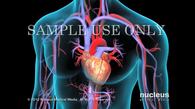 Reemplazo de válvula aórtica